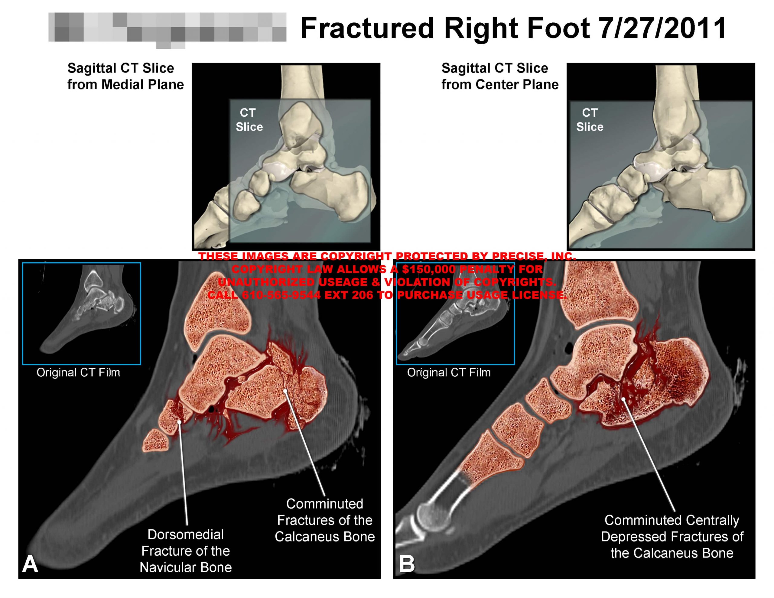 Fractured Right Foot