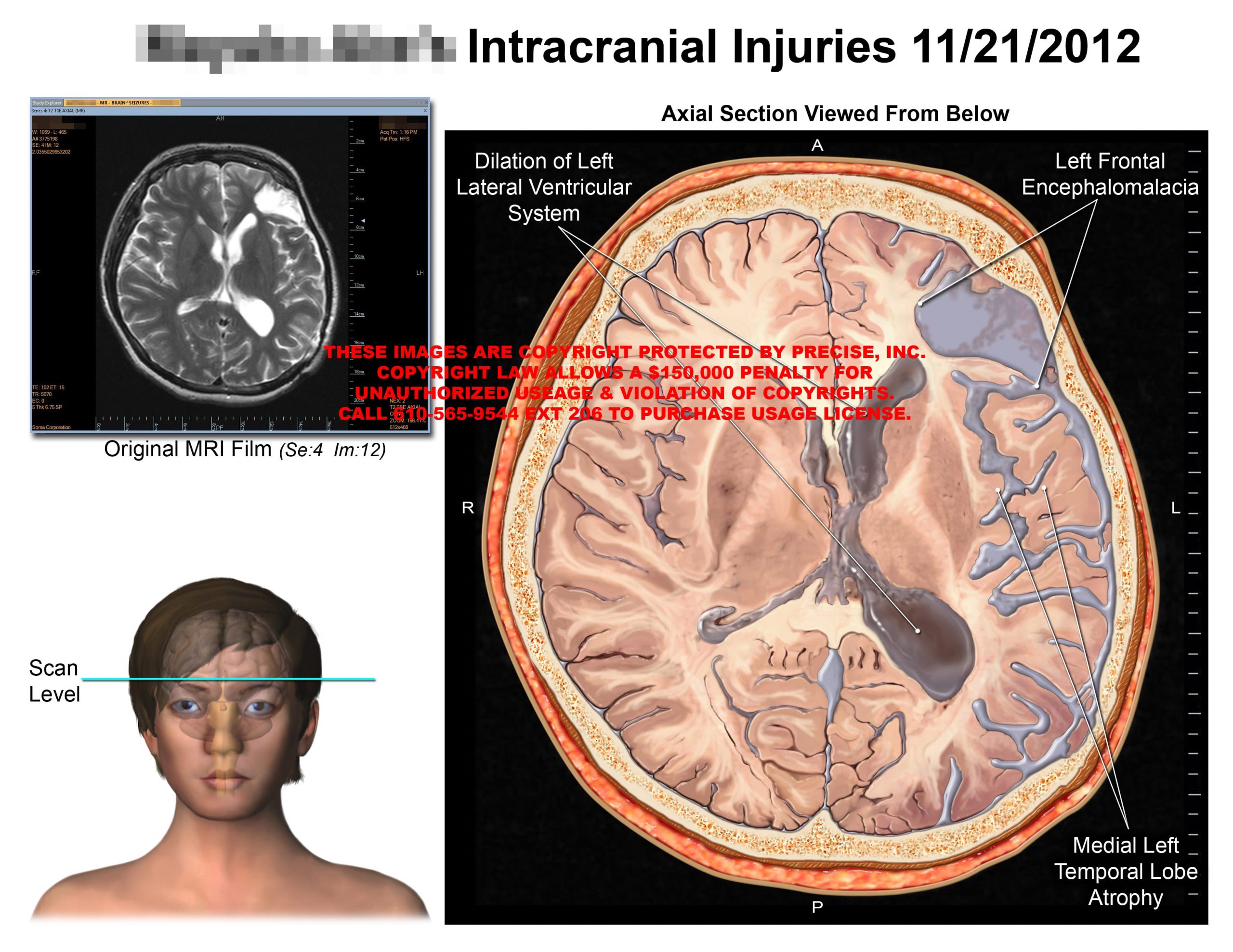 Intracranial Injuries