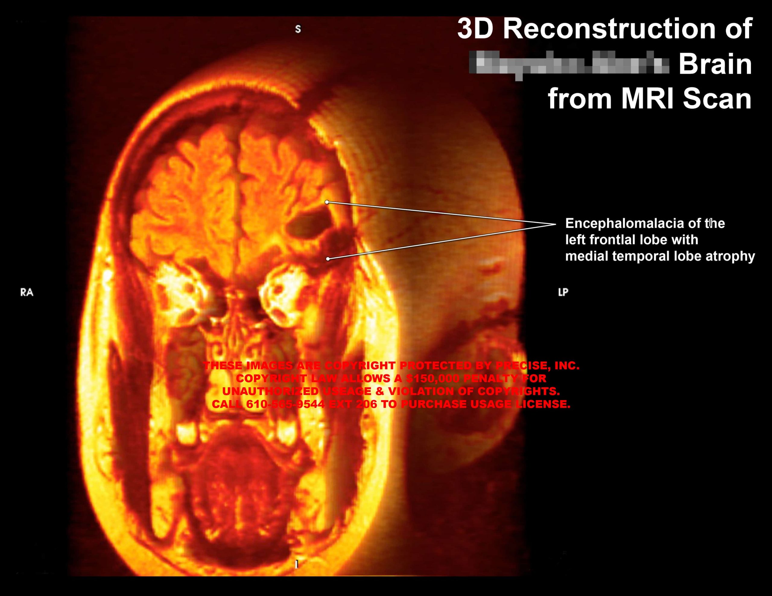 3D Reconstruction of Brain from MRI Scan